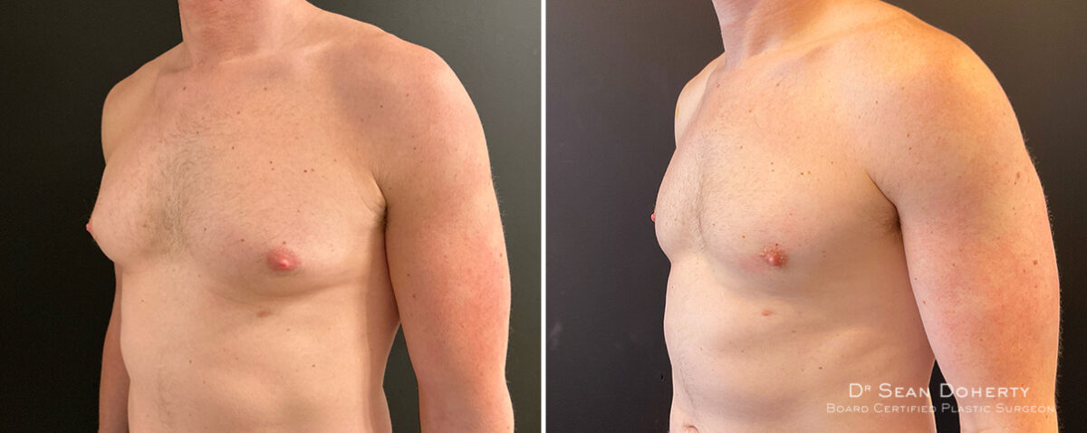 Gynecomastia Before and After Photos in Boston, MA, Patient 14517