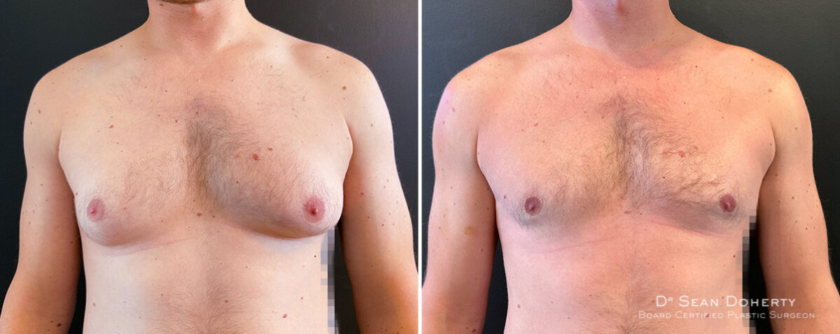 Gynecomastia Before and After Photos in Boston, MA, Patient 14527