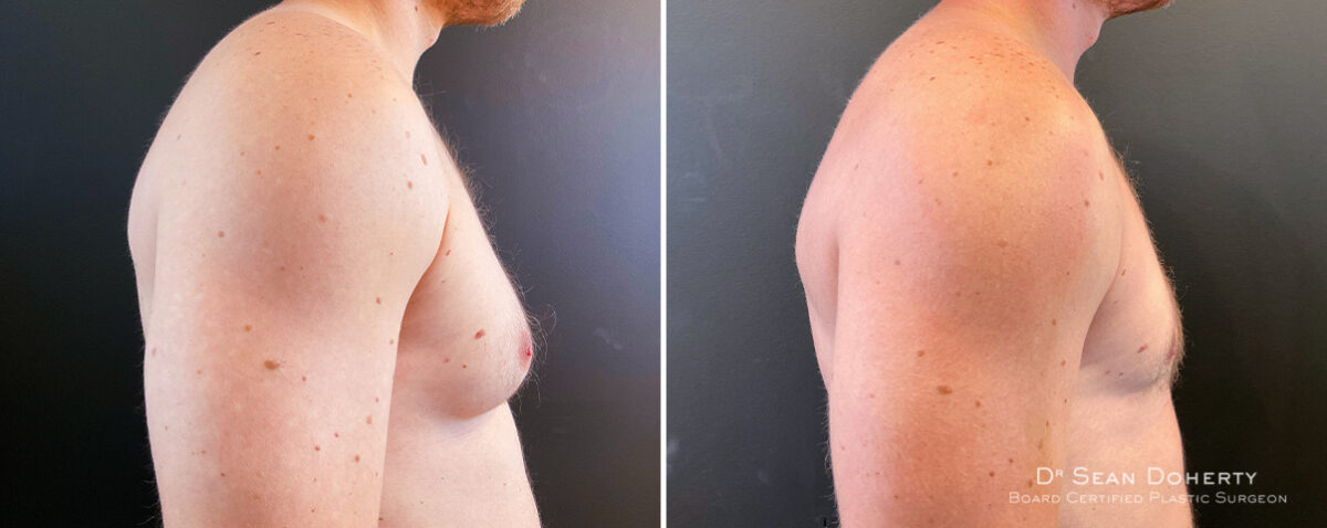 Gynecomastia Before and After Photos in Boston, MA, Patient 14527