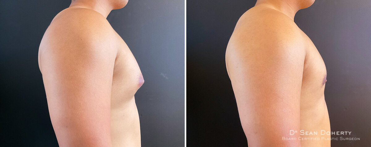Gynecomastia Before and After Photos in Boston, MA, Patient 14538
