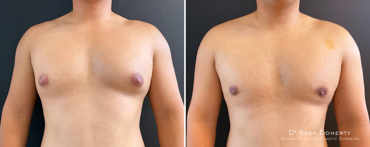 Gynecomastia Before and After Photos in Boston, MA, Patient 14538