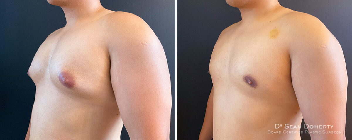 Gynecomastia Before and After Photos in Boston, MA, Patient 14538