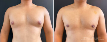 Gynecomastia Before and After Photos in Boston, MA, Patient 14538