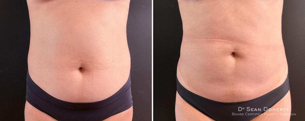 Liposuction Before and After Photos in Boston, MA, Patient 14562