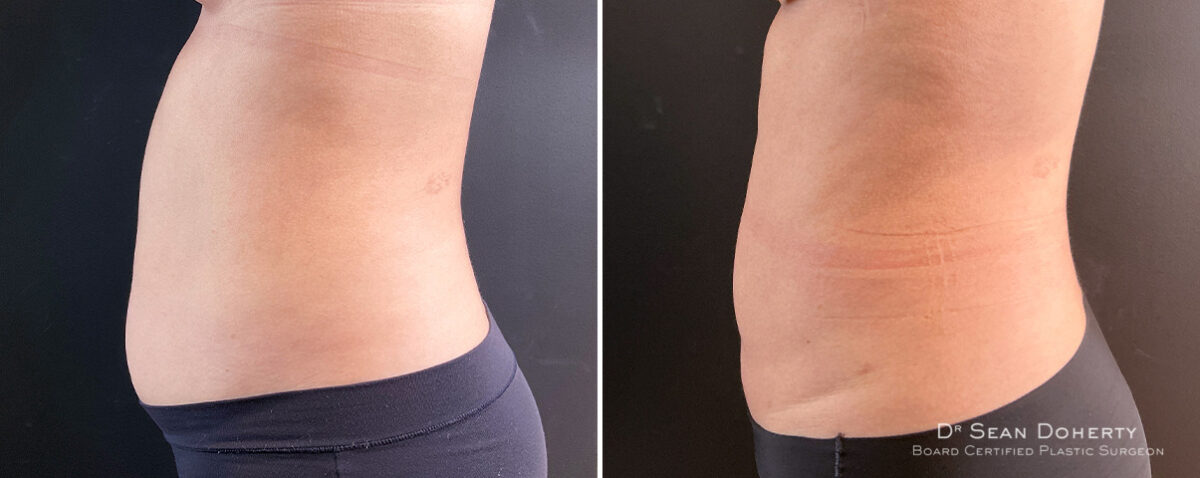 Liposuction Before and After Photos in Boston, MA, Patient 14562