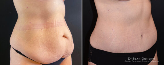 Mommy Makeover Before and After Photos in Boston, MA, Patient 14760