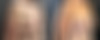 Mommy Makeover Before and After Photos in Boston, MA, Patient 14760