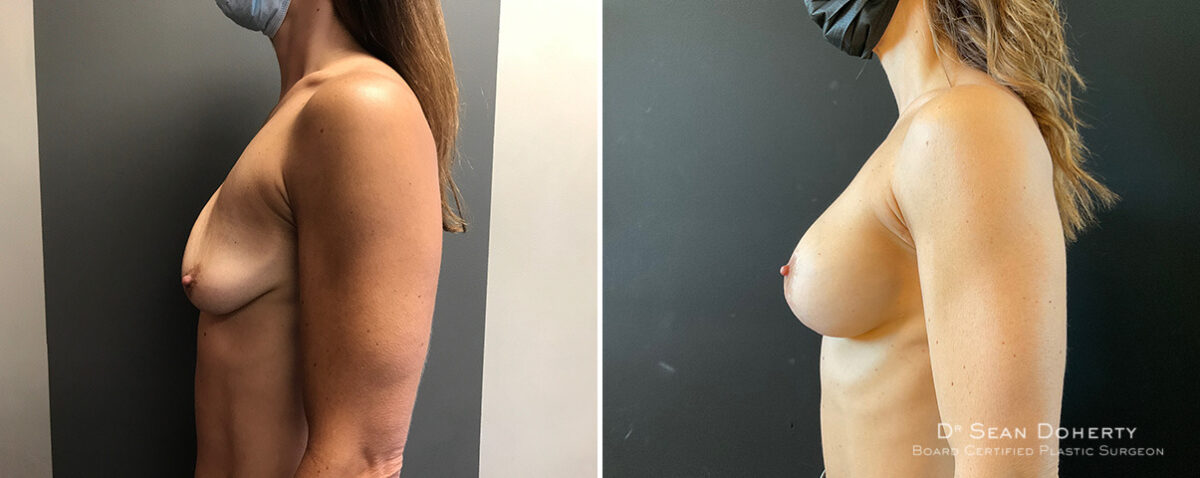 Breast Implant Exchange Before and After Photos in Boston, MA, Patient 15641