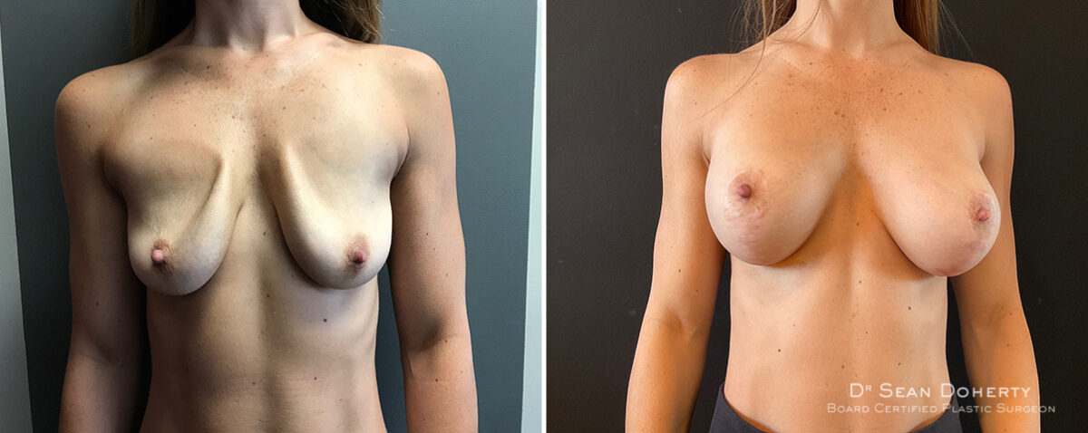 Breast Implant Exchange Before and After Photos in Boston, MA, Patient 15641