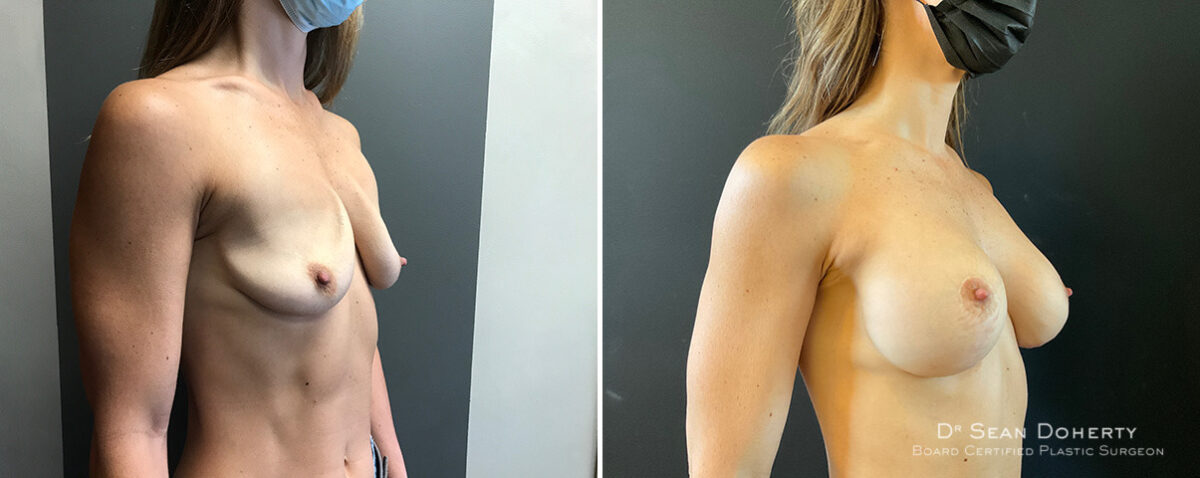 Breast Implant Exchange Before and After Photos in Boston, MA, Patient 15641