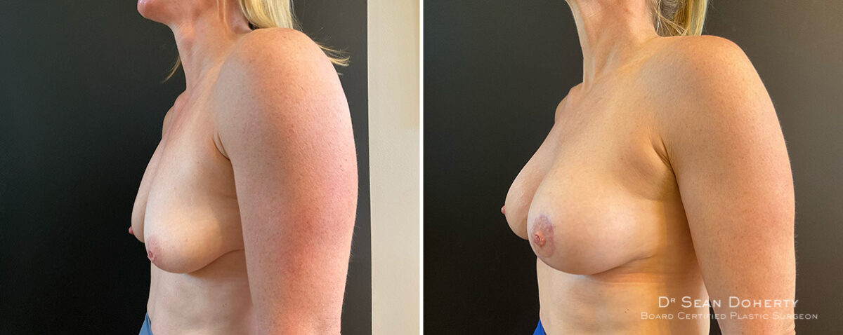 Breast Lift with Implants Before and After Photos in Boston, MA, Patient 15689
