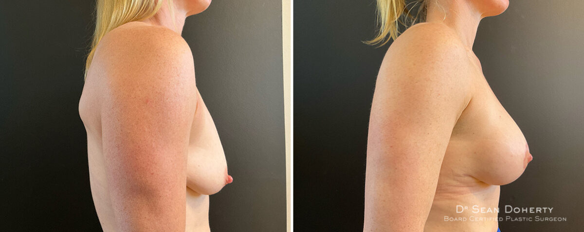 Breast Lift with Implants Before and After Photos in Boston, MA, Patient 15689