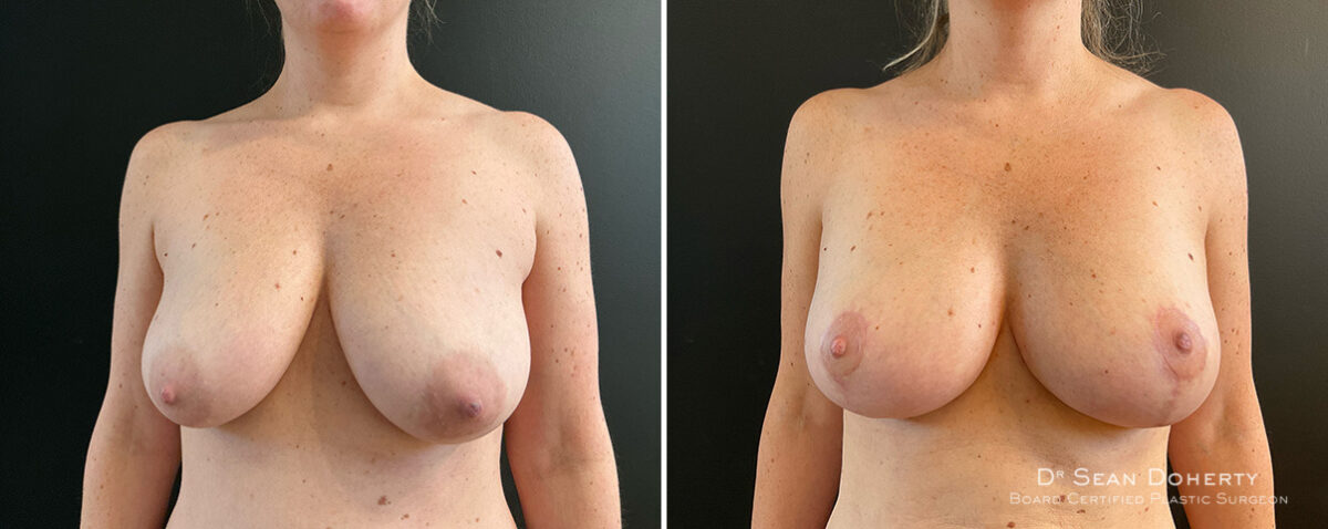 Breast Lift Before and After Photos in Boston, MA, Patient 15713