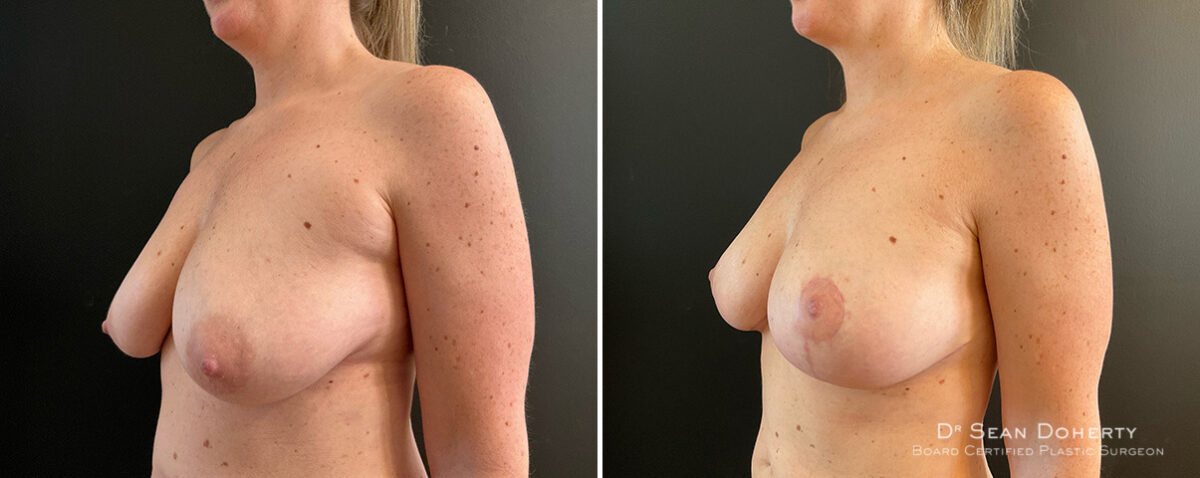 Breast Lift Before and After Photos in Boston, MA, Patient 15713