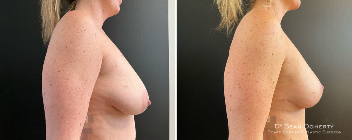 Breast Lift Before and After Photos in Boston, MA, Patient 15713