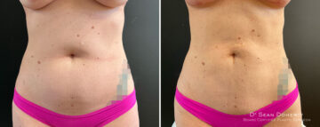 Liposuction Before and After Photos in Boston, MA, Patient 15723