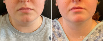 Liposuction Before and After Photos in Boston, MA, Patient 15771