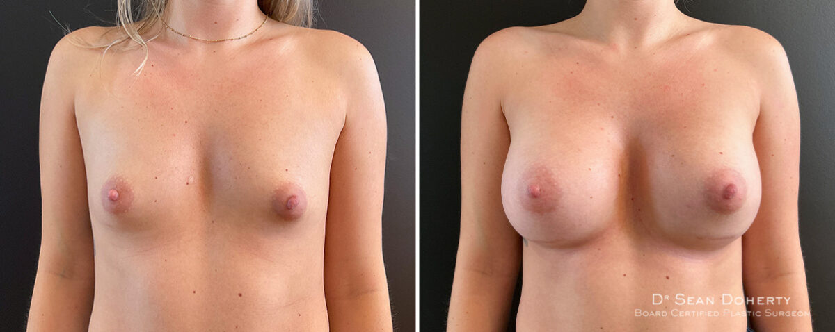 Breast Augmentation Before and After Photos in Boston, MA, Patient 16363