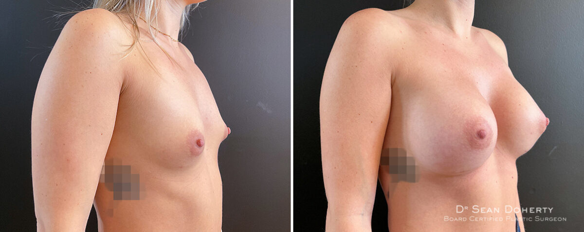 Breast Augmentation Before and After Photos in Boston, MA, Patient 16363