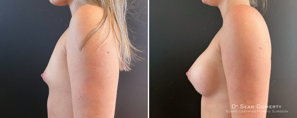 Breast Augmentation Before and After Photos in Boston, MA, Patient 16363