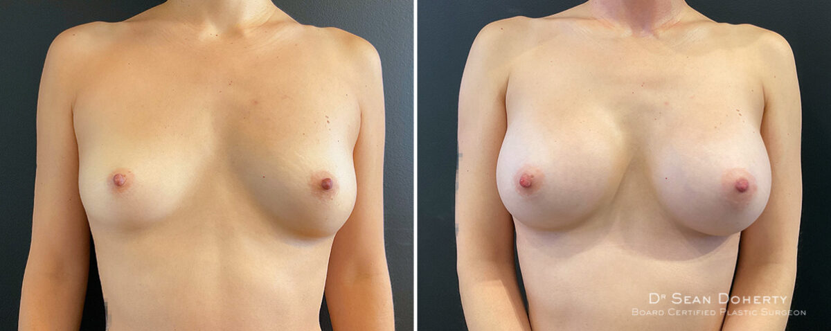 Breast Augmentation Before and After Photos in Boston, MA, Patient 16373