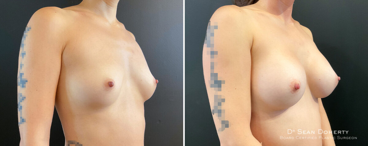 Breast Augmentation Before and After Photos in Boston, MA, Patient 16373