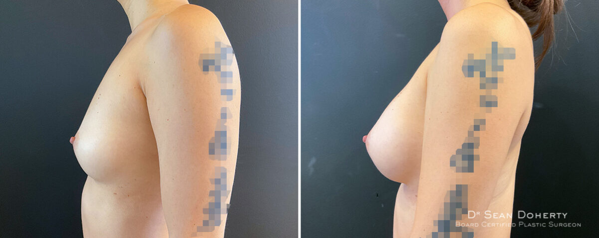 Breast Augmentation Before and After Photos in Boston, MA, Patient 16373