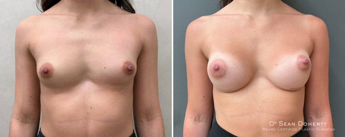Breast Augmentation Before and After Photos in Boston, MA, Patient 16383