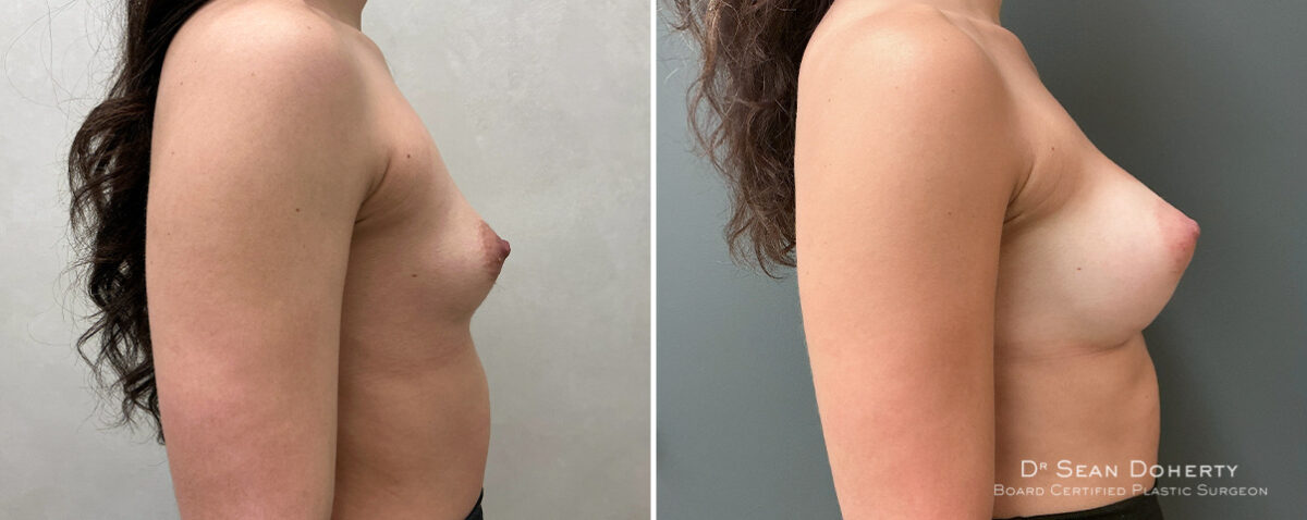 Breast Augmentation Before and After Photos in Boston, MA, Patient 16383