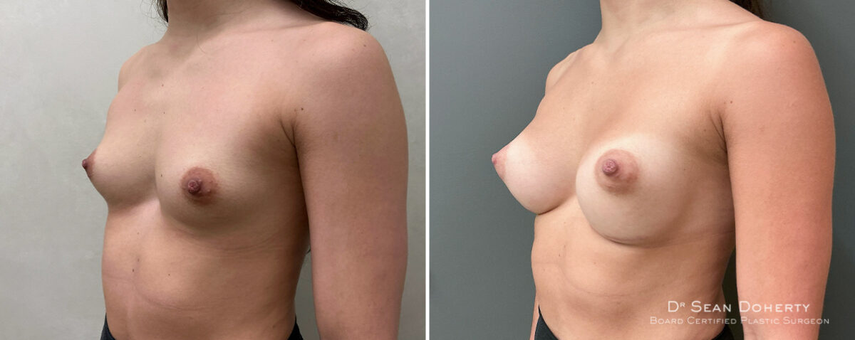Breast Augmentation Before and After Photos in Boston, MA, Patient 16383