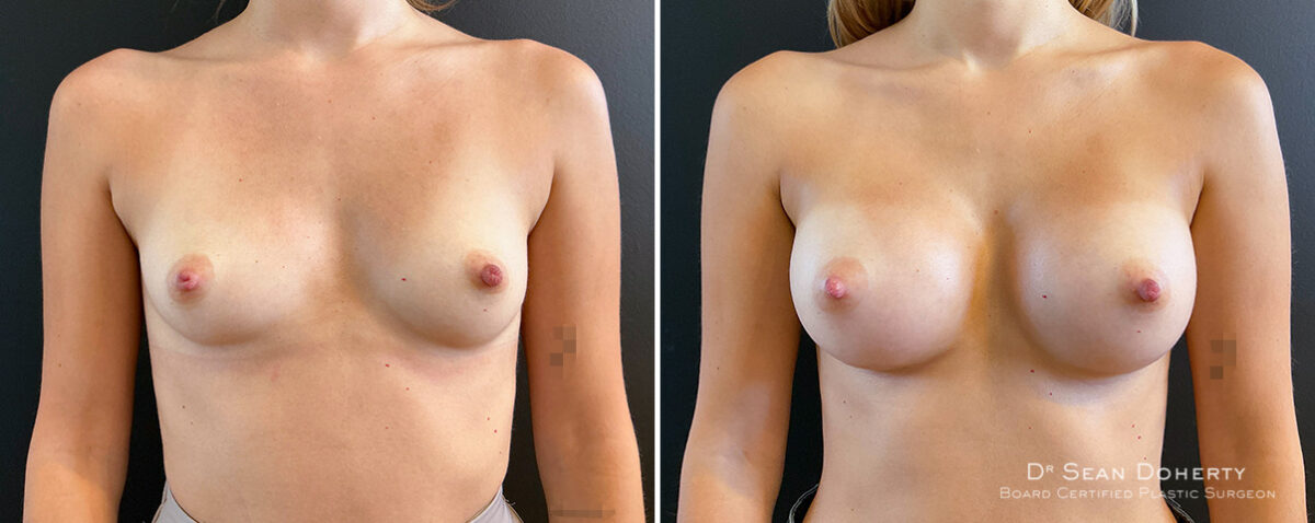 Breast Augmentation Before and After Photos in Boston, MA, Patient 16393