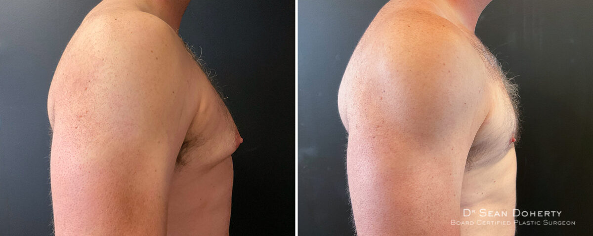 Gynecomastia Before and After Photos in Boston, MA, Patient 16408