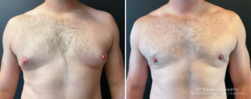 Gynecomastia Before and After Photos in Boston, MA, Patient 16408