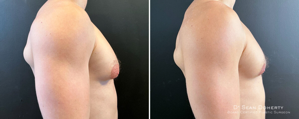 Gynecomastia Before and After Photos in Boston, MA, Patient 16418