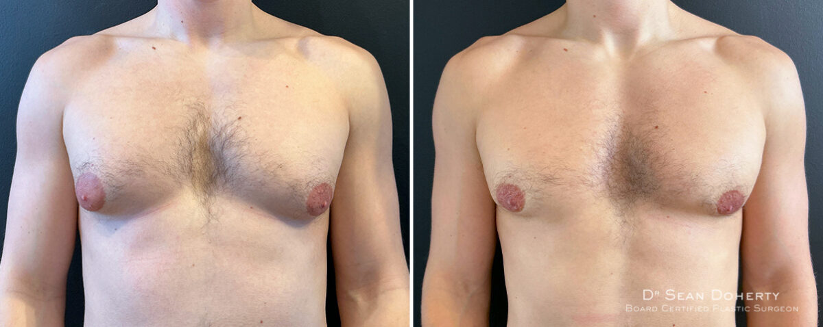 Gynecomastia Before and After Photos in Boston, MA, Patient 16418