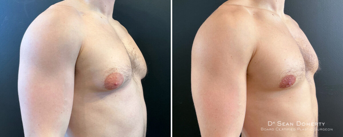 Gynecomastia Before and After Photos in Boston, MA, Patient 16418