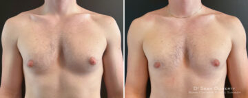 Gynecomastia Before and After Photos in Boston, MA, Patient 16428