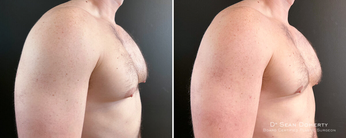Gynecomastia Before and After Photos in Boston, MA, Patient 16438