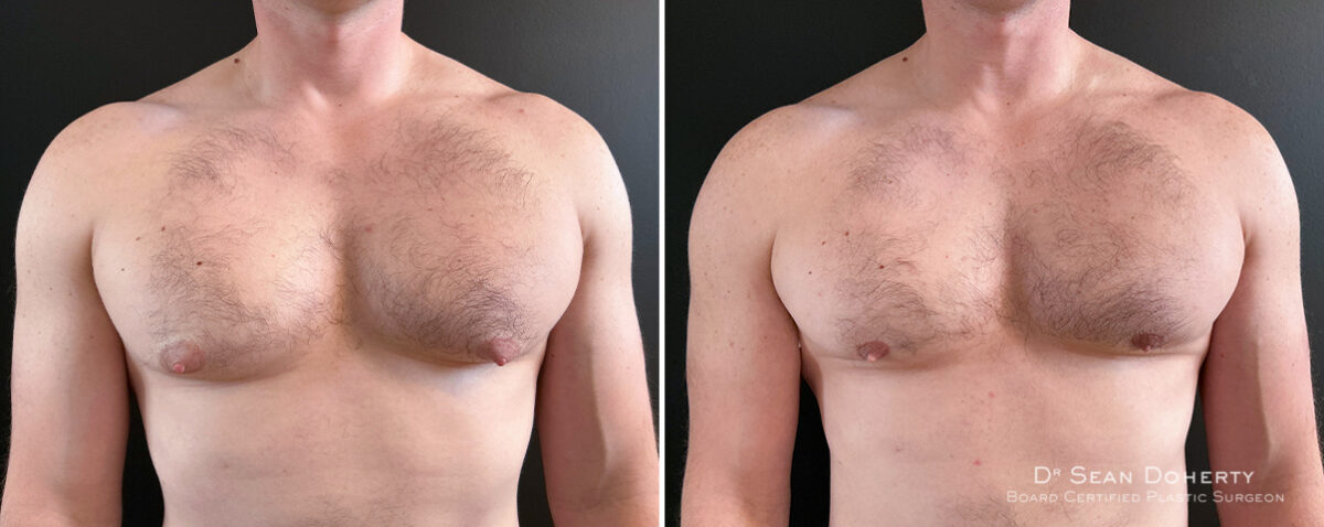 Gynecomastia Before and After Photos in Boston, MA, Patient 16438