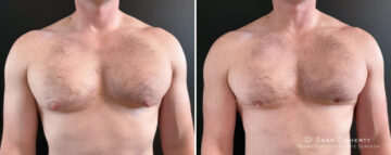 Gynecomastia Before and After Photos in Boston, MA, Patient 16438