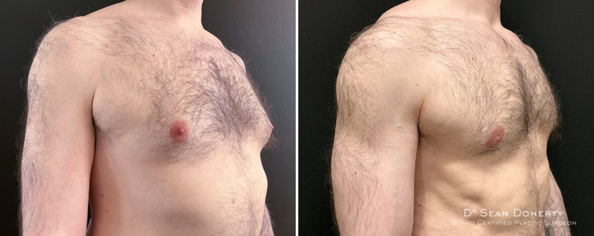 Gynecomastia Before and After Photos in Boston, MA, Patient 16448