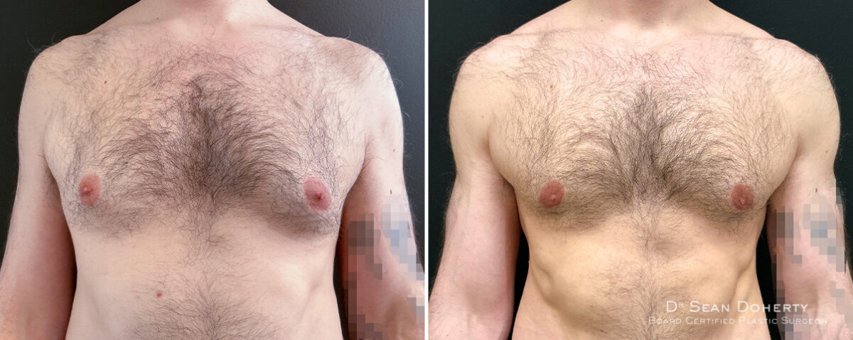 Gynecomastia Before and After Photos in Boston, MA, Patient 16448