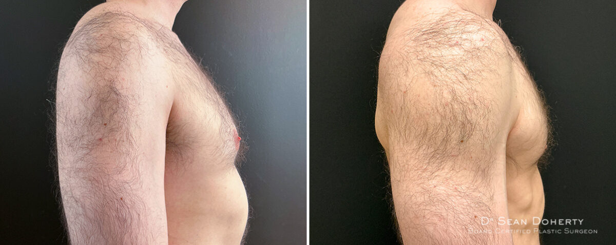 Gynecomastia Before and After Photos in Boston, MA, Patient 16448