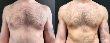 Gynecomastia Before and After Photos in Boston, MA, Patient 16448