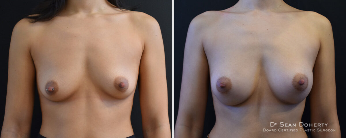 Breast Augmentation Before and After Photos in Boston, MA, Patient 16474