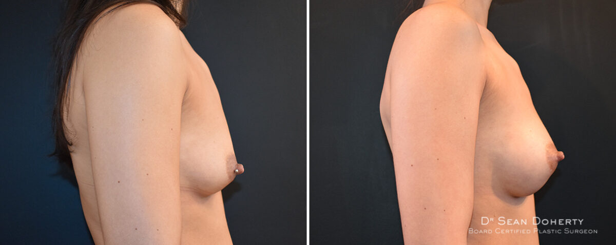 Breast Augmentation Before and After Photos in Boston, MA, Patient 16474