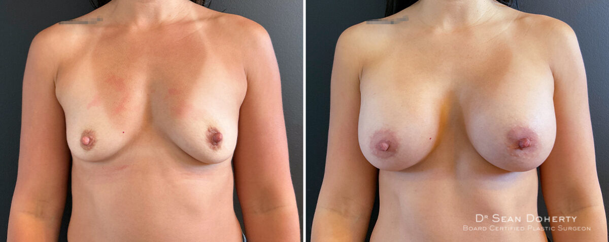 Breast Augmentation Before and After Photos in Boston, MA, Patient 16484