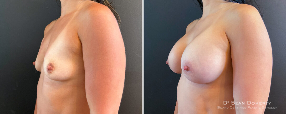 Breast Augmentation Before and After Photos in Boston, MA, Patient 16484