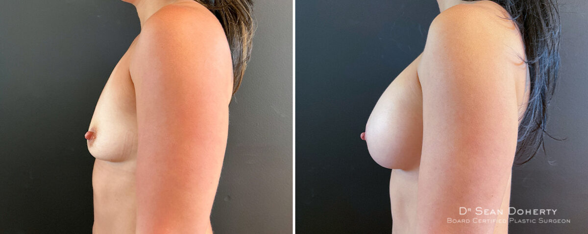 Breast Augmentation Before and After Photos in Boston, MA, Patient 16484