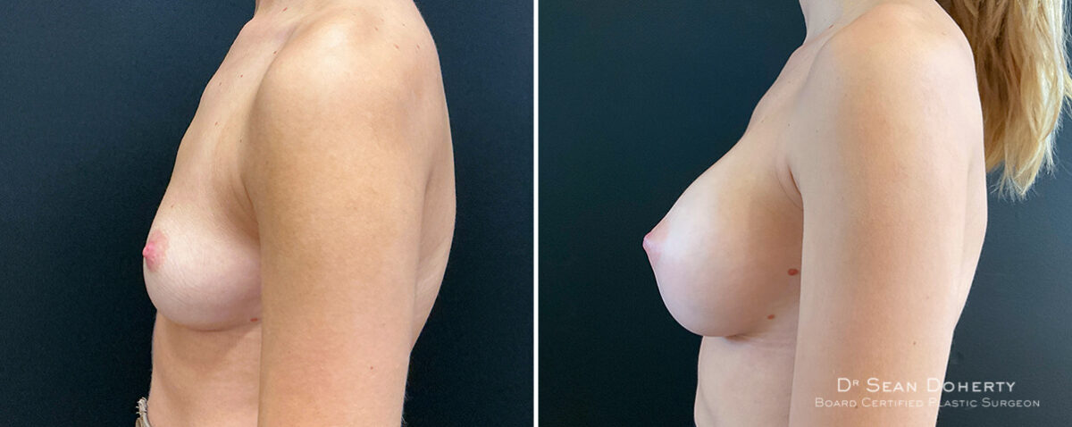 Breast Augmentation Before and After Photos in Boston, MA, Patient 16494